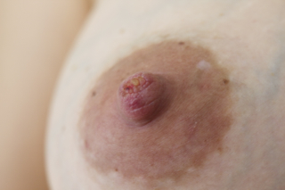 cracked nipples